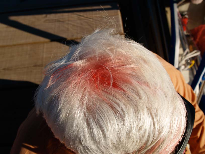Photo: Head laceration.